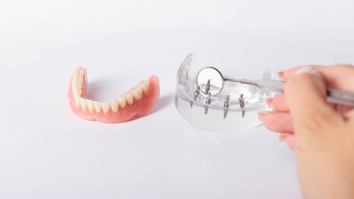 Illustration of All-on-4 dental implants in the lower jaw with attached fixed bridge