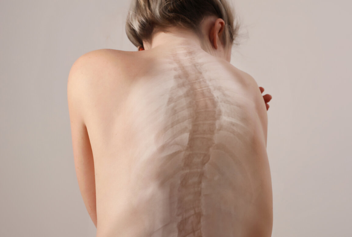 Symptom of Scoliosis