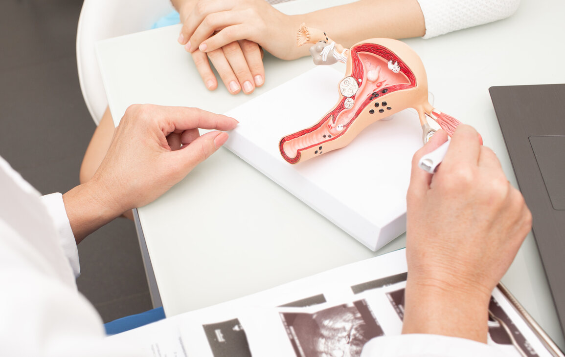 What are Uterine fibroid