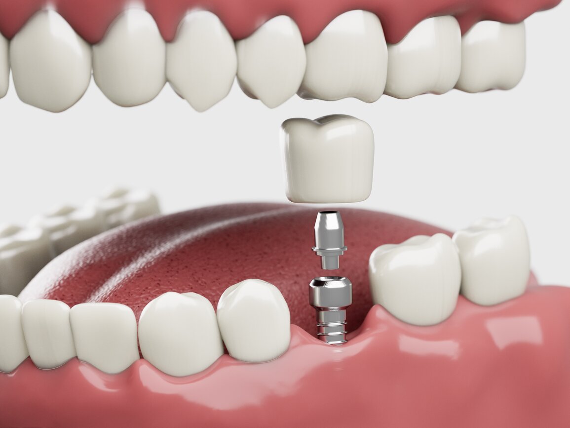 Different Types of Dental Implant