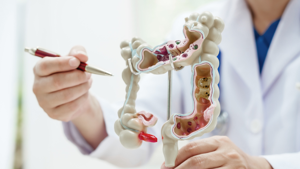 A doctor explains with an intestinal model on detecting colon cancer. Stool is one telltale sign.