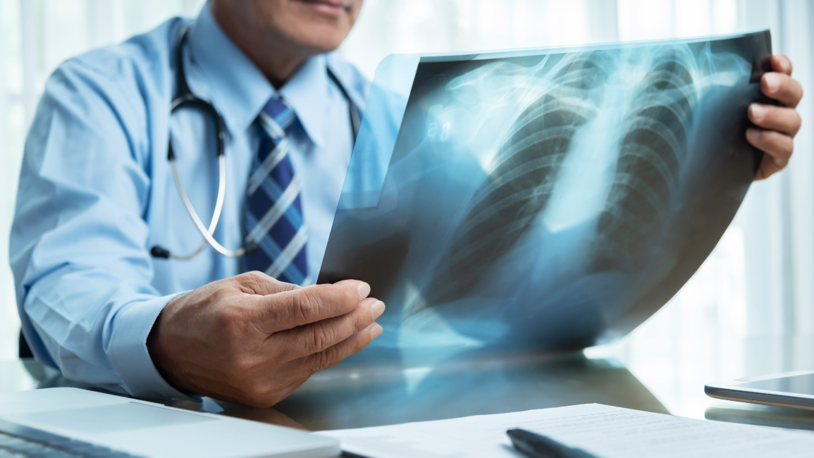 Doctor reviewing chest X-ray film to identify lung cancer early symptoms