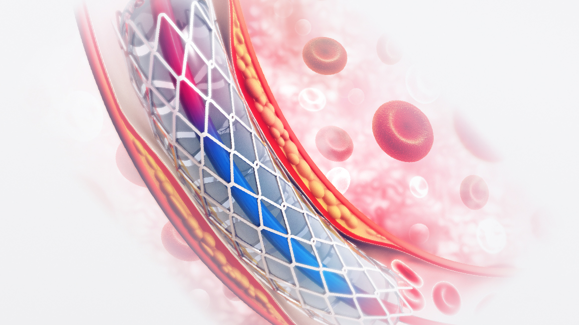 Procedure of Balloon Angioplasty
