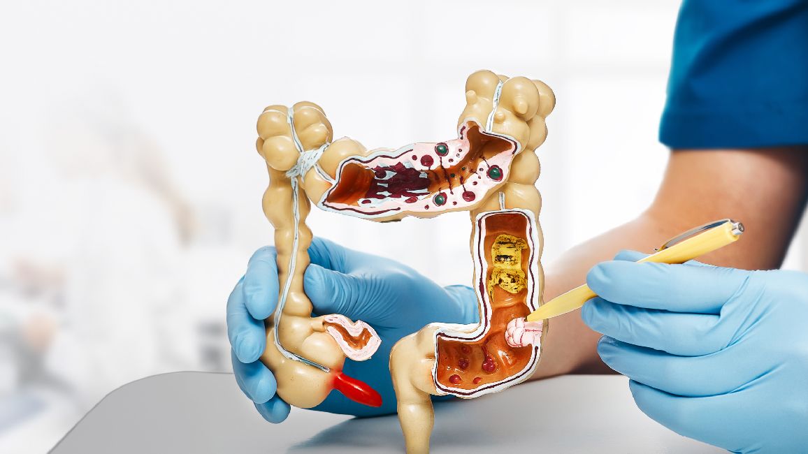 Expect After the Colonoscopy