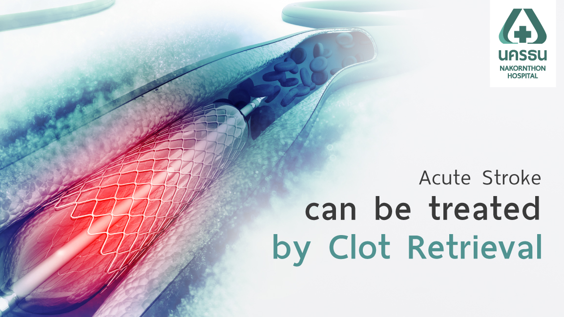 Endovascular clot retrieval for ischemic or acute stroke