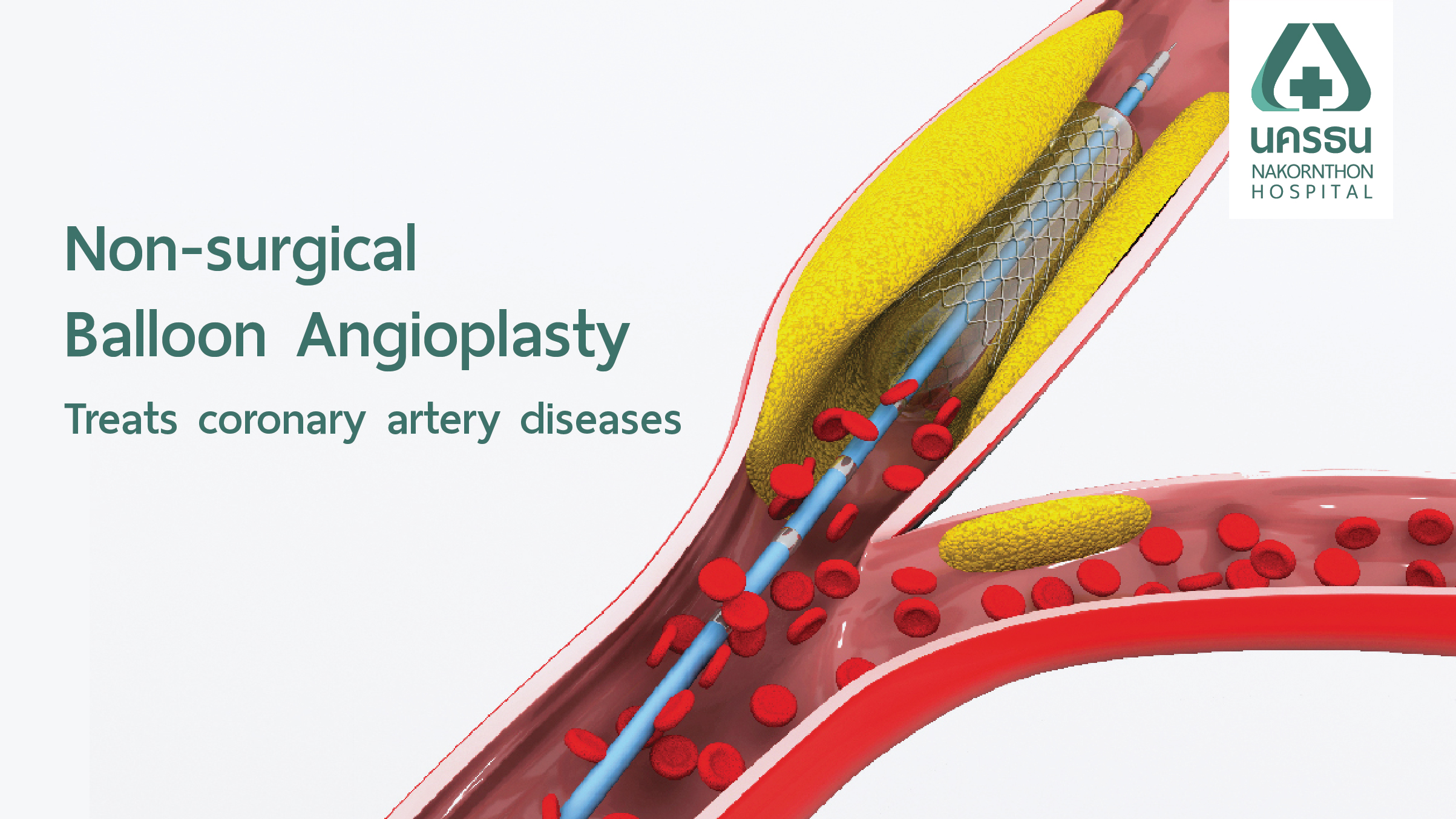 Rescue Intracranial Balloon Angioplasty With Or Without Stent – GZRGVU