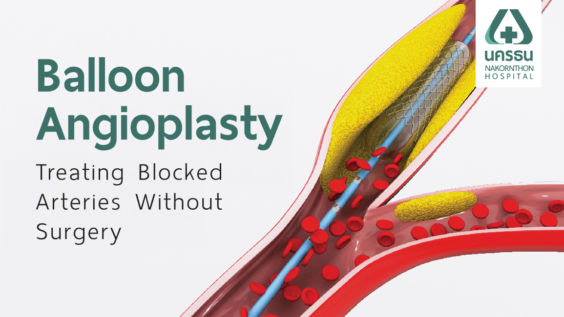 Balloon Angioplasty Balloon Angioplasty