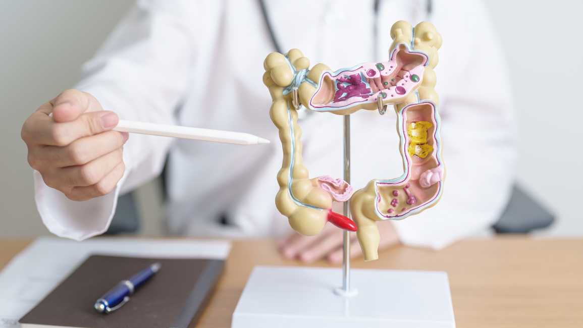 A woman with an anatomical model for colorectal cancer. Several symptoms can be present