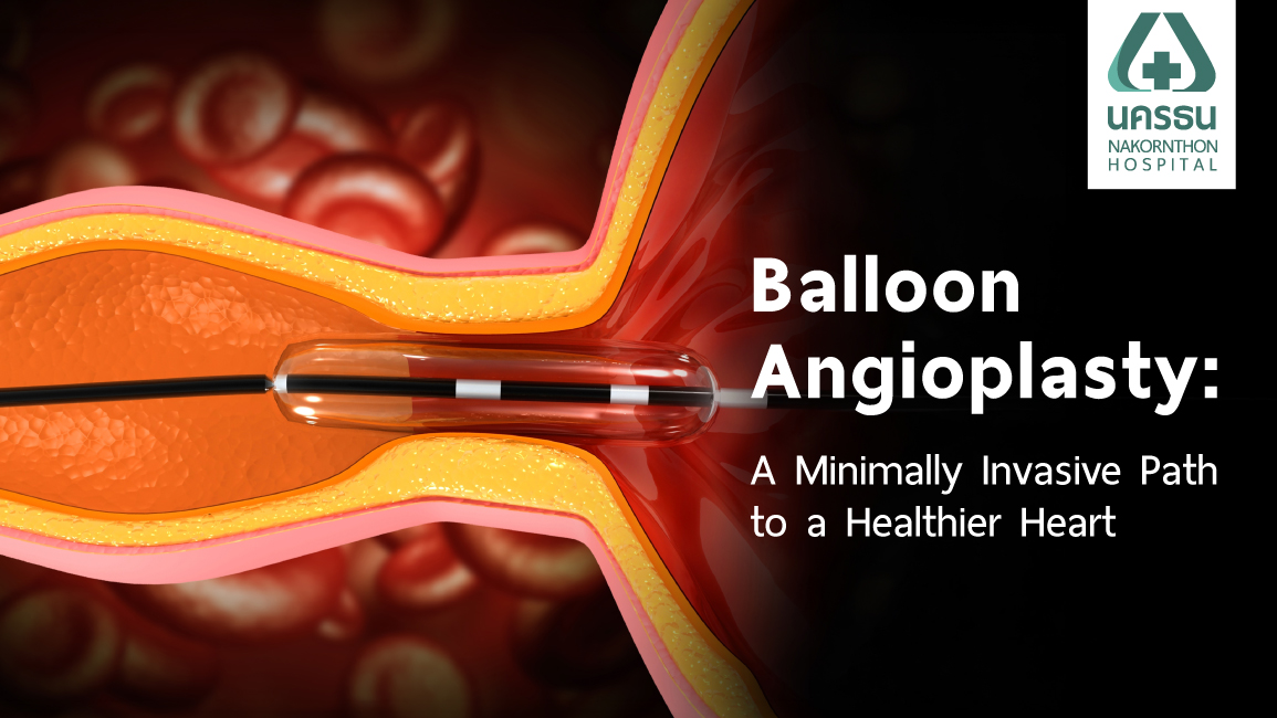 Illustration of plaque buildup in coronary artery disease, treated via balloon angioplasty at Nakornthon Hospital.