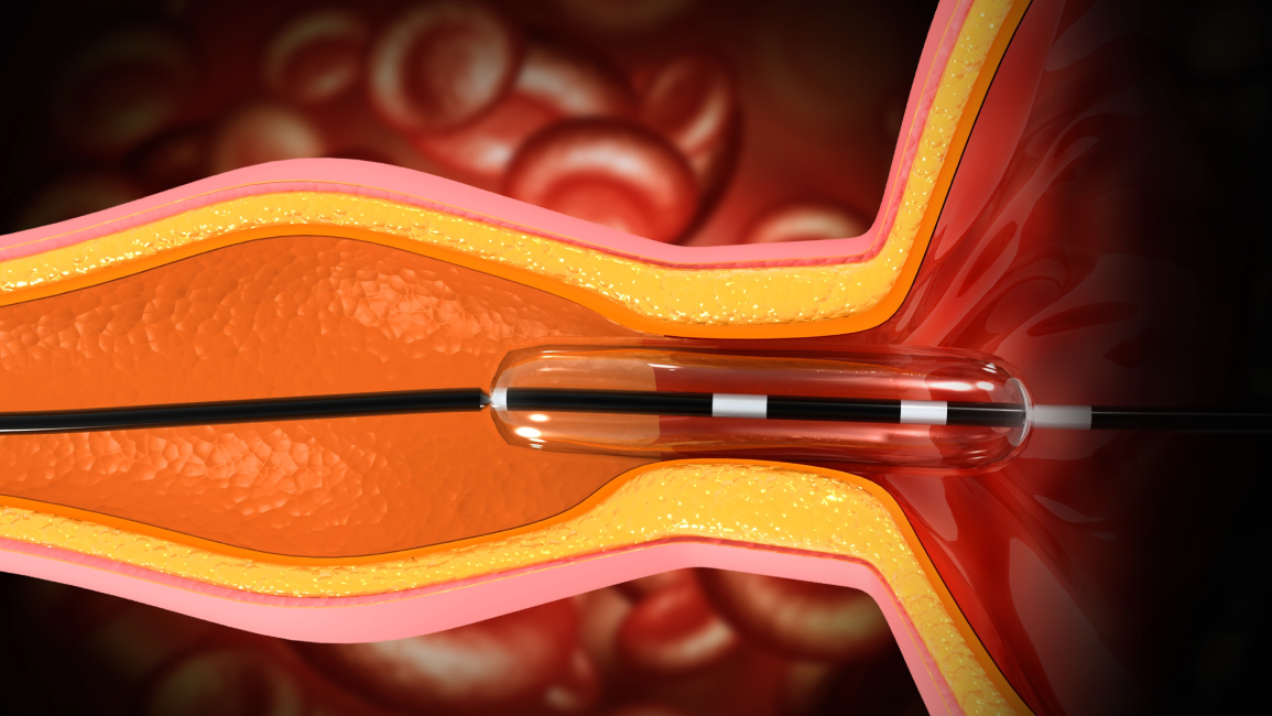 Illustration of plaque buildup in coronary artery disease, treated via balloon angioplasty at Nakornthon Hospital.