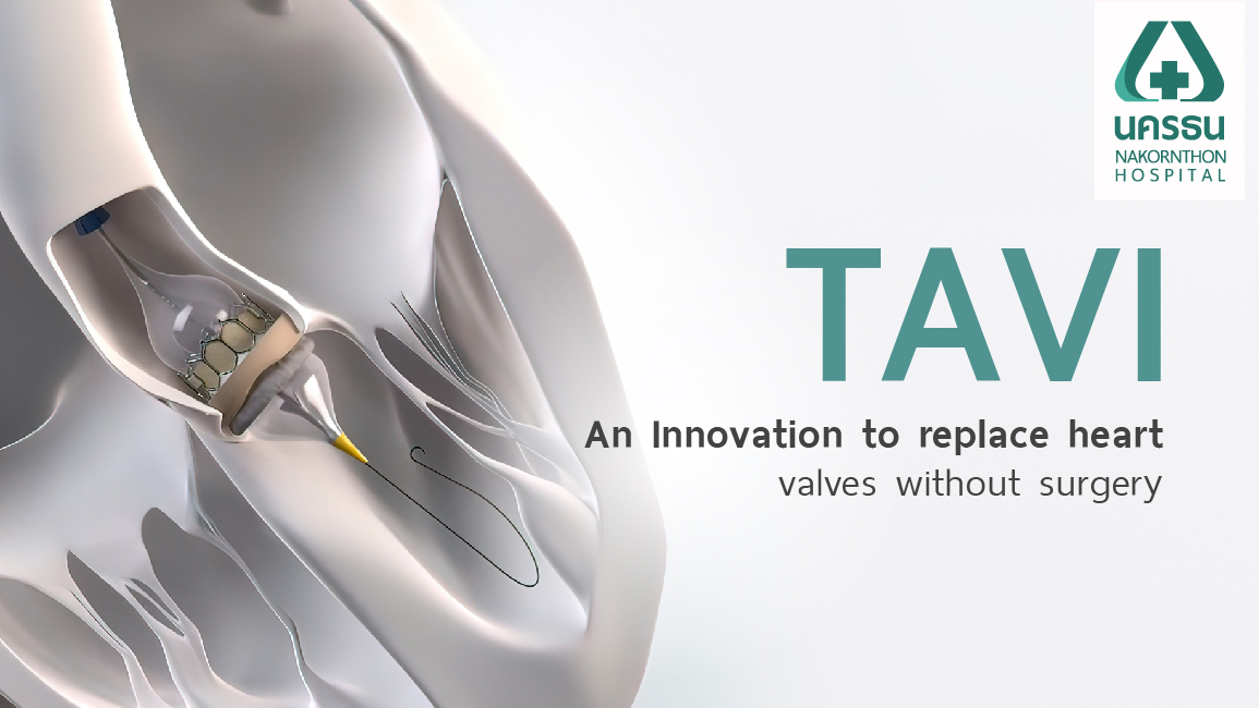 TAVI innovation replacing aortic heart valve through a catheter without open chest surgery